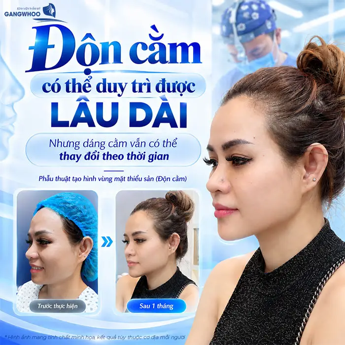 Độn Cằm Có Được Vĩnh Viễn Không? Những Yếu Tố Ảnh Hưởng