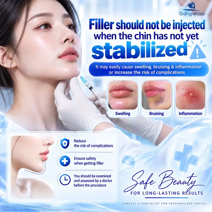 Can You Get Filler After Chin Augmentation? How Long Should You Wait Before Getting Filler? 3 Filler should not be injected when the chin has not yet stabilized, as this may cause various serious complications