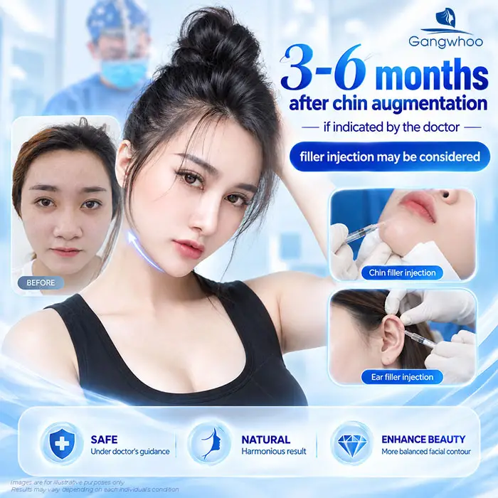 Can You Get Filler After Chin Augmentation? How Long Should You Wait Before Getting Filler? 2 After 3–6 months following chin augmentation, filler may be considered if recommended by the doctor