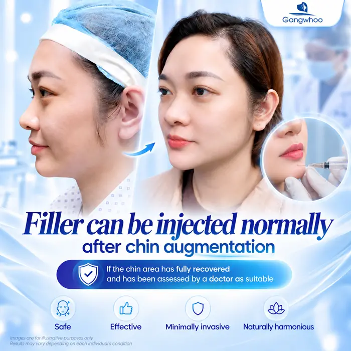 Can You Get Filler After Chin Augmentation? How Long Should You Wait Before Getting Filler? 1 Filler can be injected normally after chin augmentation if the chin area has healed and the doctor determines that the procedure is appropriate