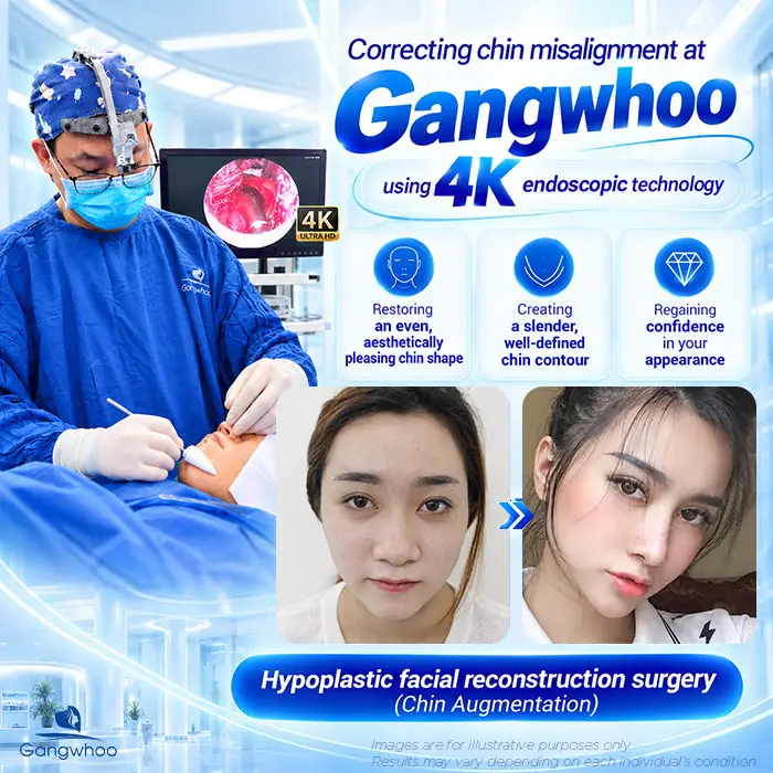 Chin revision at Gangwhoo uses 4K endoscopic technology to restore an even, aesthetically pleasing, and more refined chin contour