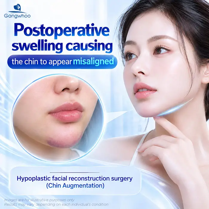 Postoperative swelling can make the chin appear more misaligned than usual