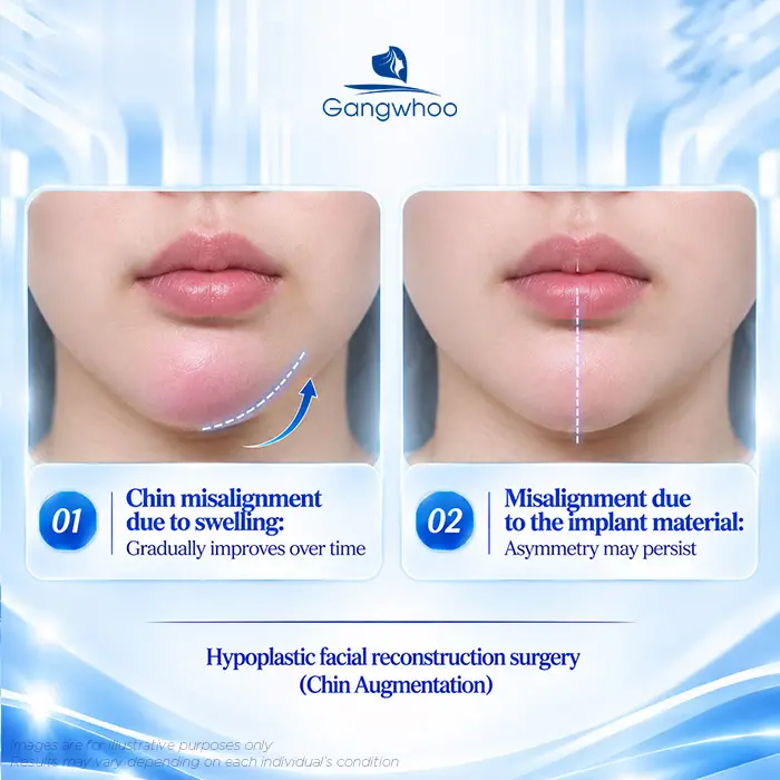 Distinguishing chin asymmetry caused by swelling from asymmetry caused by implant displacement