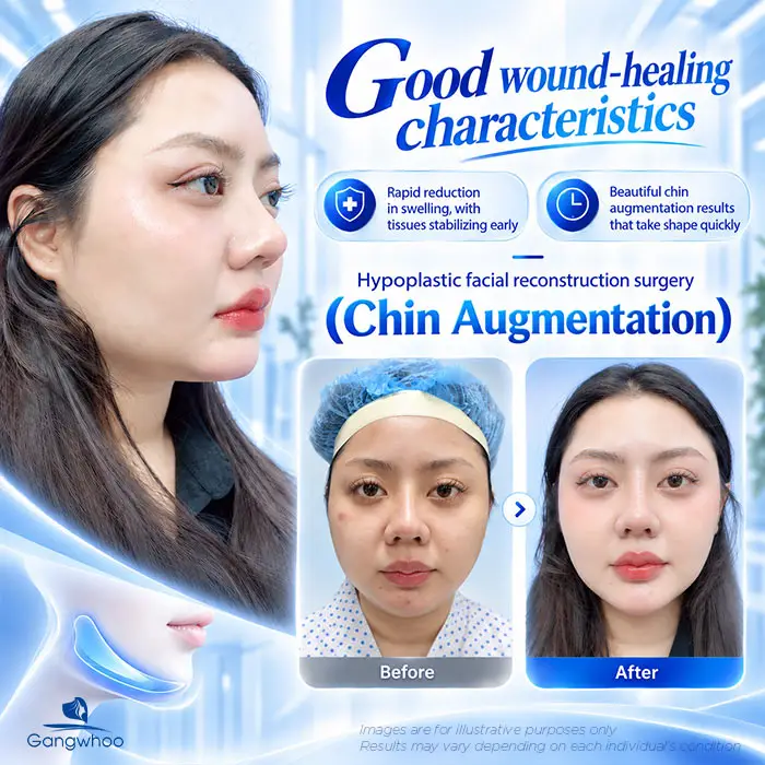 Is Chin Augmentation Permanent? Factors That Affect Longevity 4 en don cam co duoc vinh vien khong 2