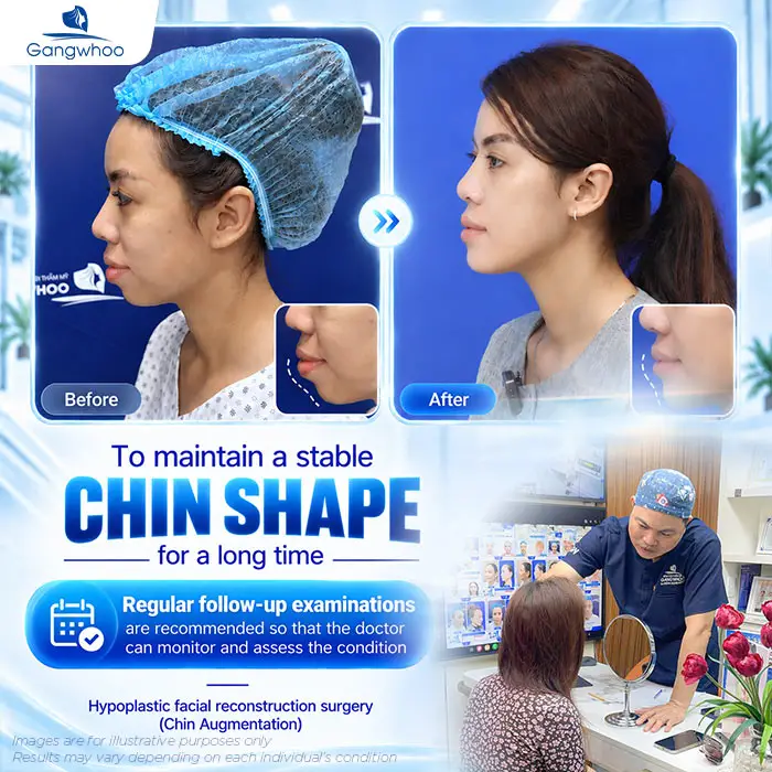 Is Chin Augmentation Permanent? Factors That Affect Longevity 6 en don cam co duoc vinh vien khong 3