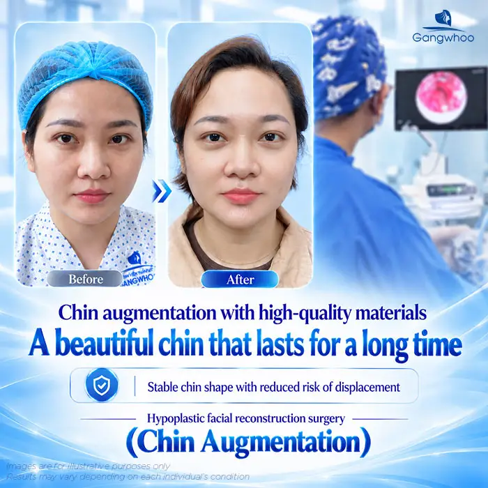 Is Chin Augmentation Permanent? Factors That Affect Longevity 3 en don cam co duoc vinh vien khong 4