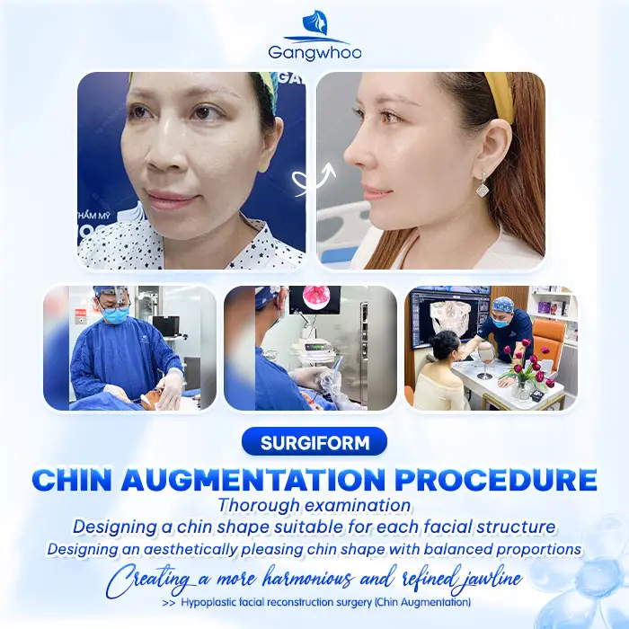 What Is Surgiform Chin Augmentation? How Much Does It Cost? 4 en don cam sun surgiform 2