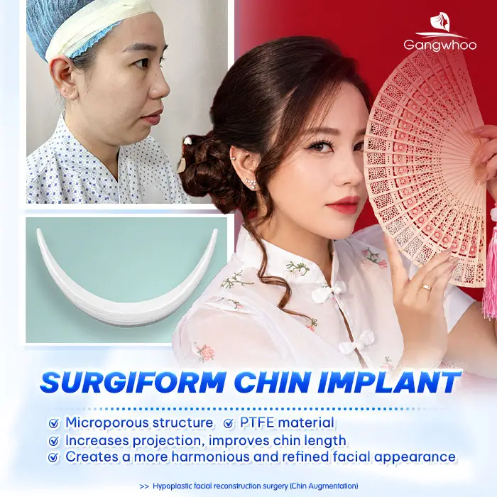 What Is Surgiform Chin Augmentation? How Much Does It Cost? 2 en don cam sun surgiform 3