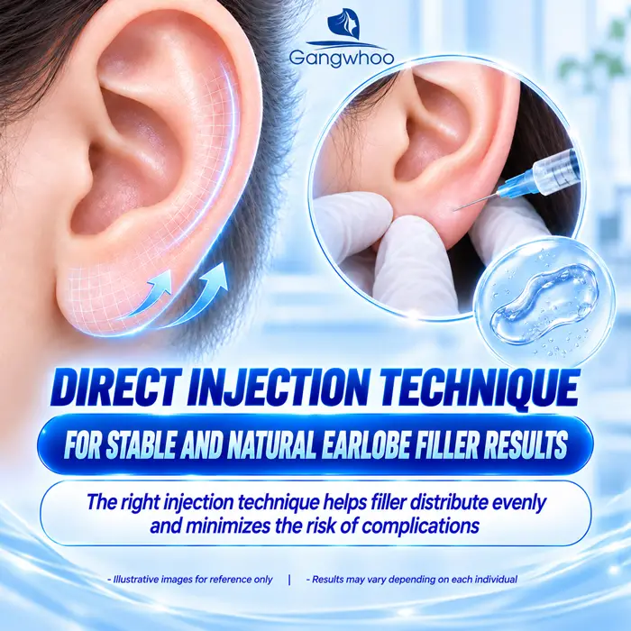 Injection technique directly affects filler stability; proper injection technique helps distribute filler evenly