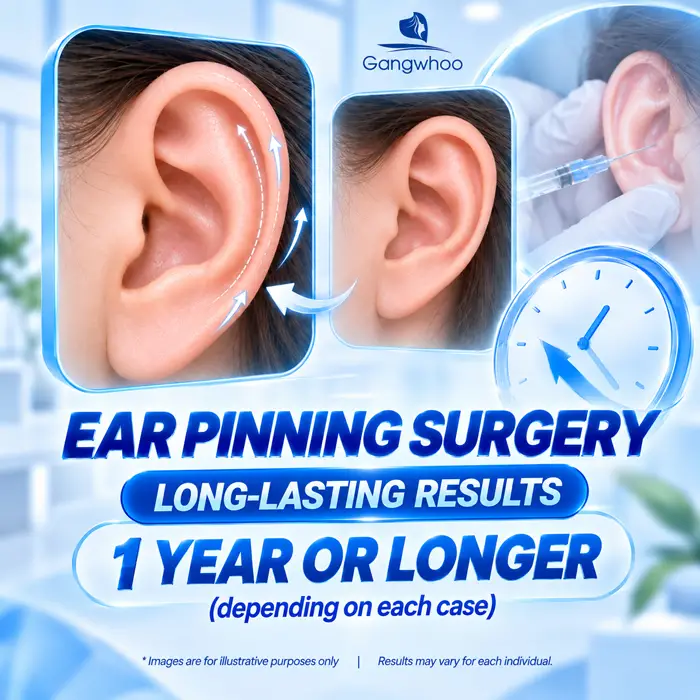 Fortune ear filler typically lasts around 1 year or longer depending on each individual case
