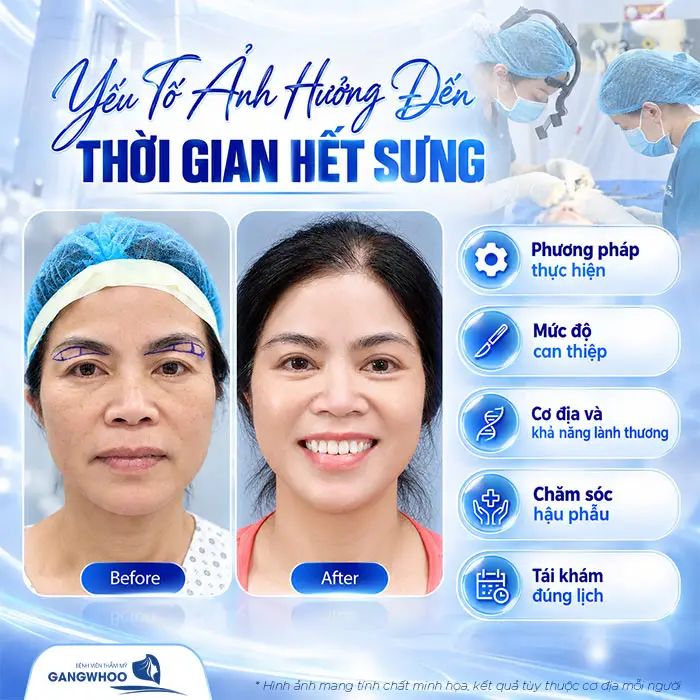 Yếu tố ảnh hưởng đến thời gian hết sưng sau thực hiện nâng cung chân mày