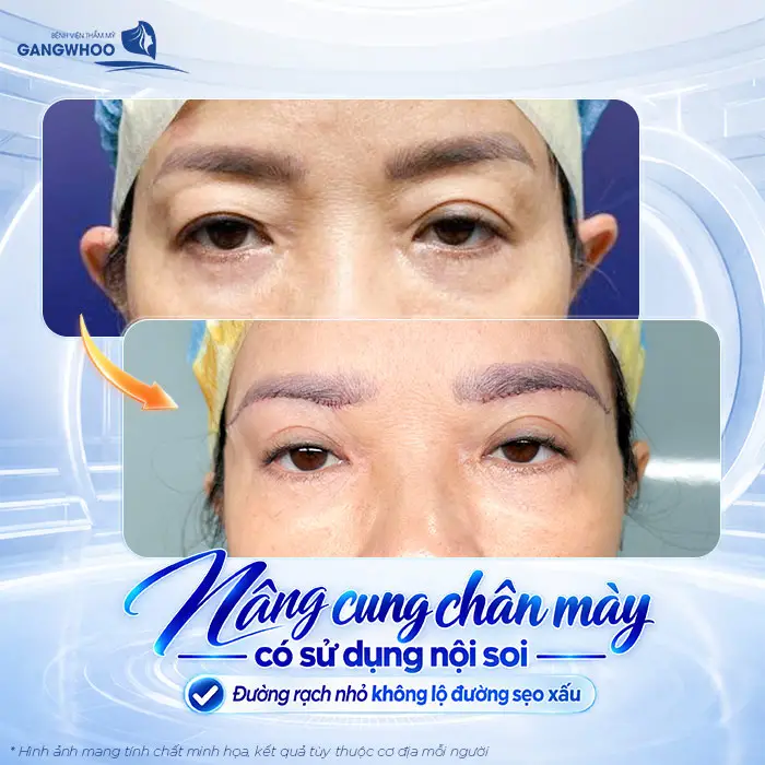 Nâng Cung Chân Mày Có Để Lại Sẹo Không? Hướng Dẫn Chăm Sóc Hạn Chế Sẹo