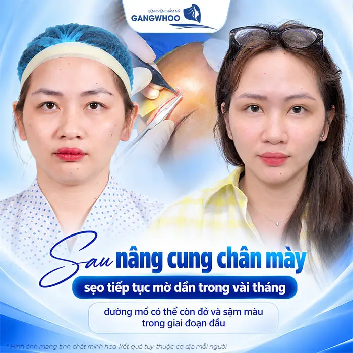 Nâng Cung Chân Mày Có Để Lại Sẹo Không? Hướng Dẫn Chăm Sóc Hạn Chế Sẹo