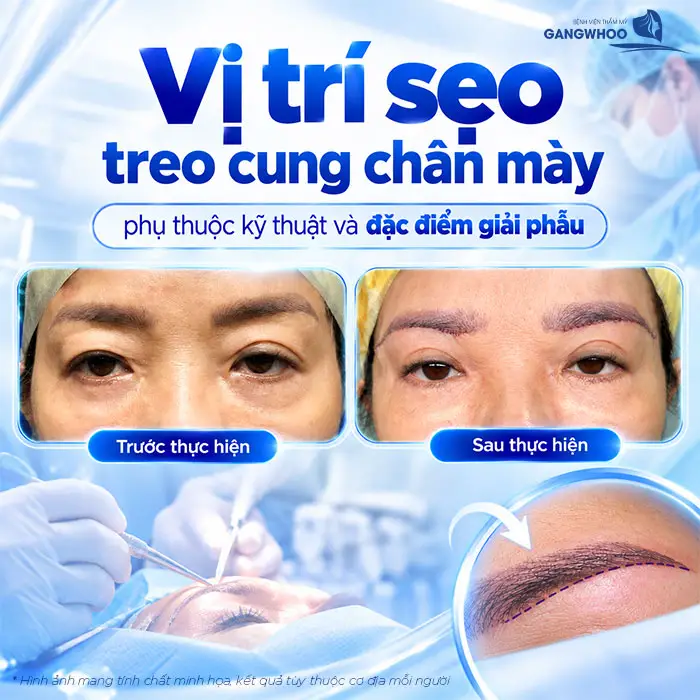 Nâng Cung Chân Mày Có Để Lại Sẹo Không? Hướng Dẫn Chăm Sóc Hạn Chế Sẹo