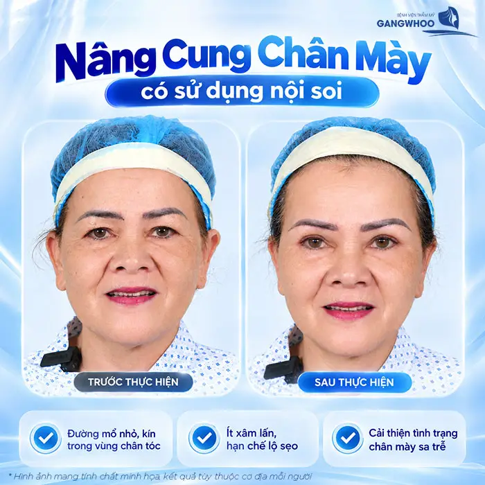 Nâng Cung Chân Mày Có Để Lại Sẹo Không? Hướng Dẫn Chăm Sóc Hạn Chế Sẹo