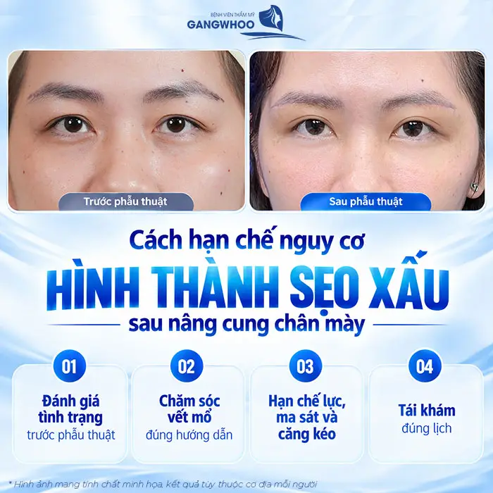 Nâng Cung Chân Mày Có Để Lại Sẹo Không? Hướng Dẫn Chăm Sóc Hạn Chế Sẹo