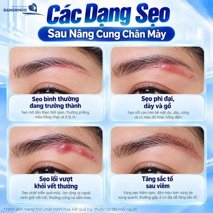 Nâng Cung Chân Mày Có Để Lại Sẹo Không? Hướng Dẫn Chăm Sóc Hạn Chế Sẹo