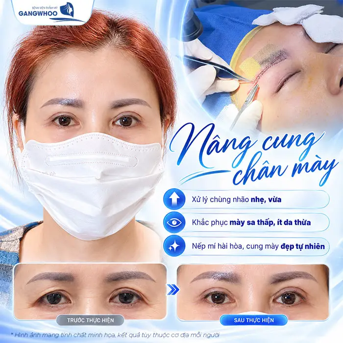 Nâng cung chân mày có thể duy trì được nhiều năm nhưng không thể vĩnh viễn