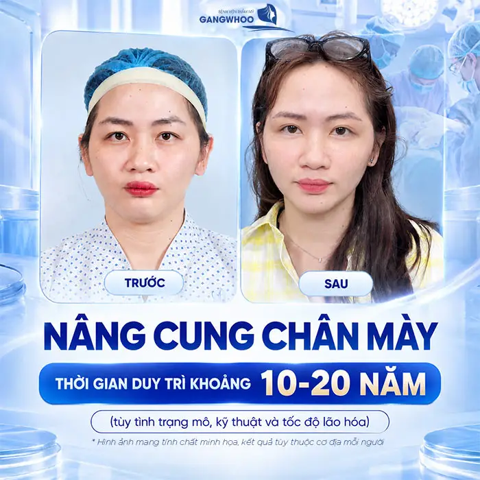 Nâng Cung Chân Mày Giữ Được Bao Lâu? Hướng Dẫn Chăm Sóc
