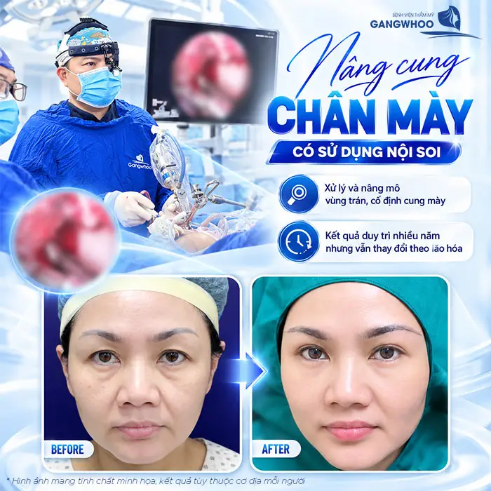 Nâng Cung Chân Mày Giữ Được Bao Lâu? Hướng Dẫn Chăm Sóc