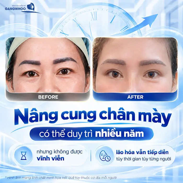 Nâng Cung Chân Mày Giữ Được Bao Lâu? Hướng Dẫn Chăm Sóc