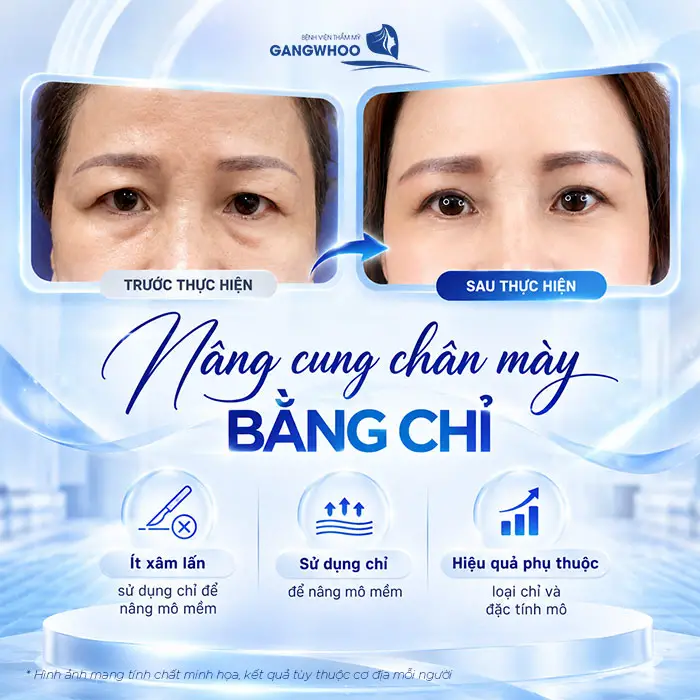 Nâng Cung Chân Mày Giữ Được Bao Lâu? Hướng Dẫn Chăm Sóc
