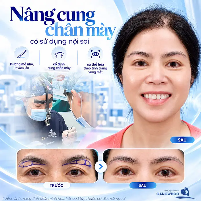 Nâng cung chân mày có thể duy trì được nhiều năm nhưng không thể vĩnh viễn