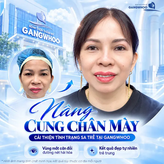  Nâng cung chân mày có thể duy trì được nhiều năm nhưng không thể vĩnh viễn