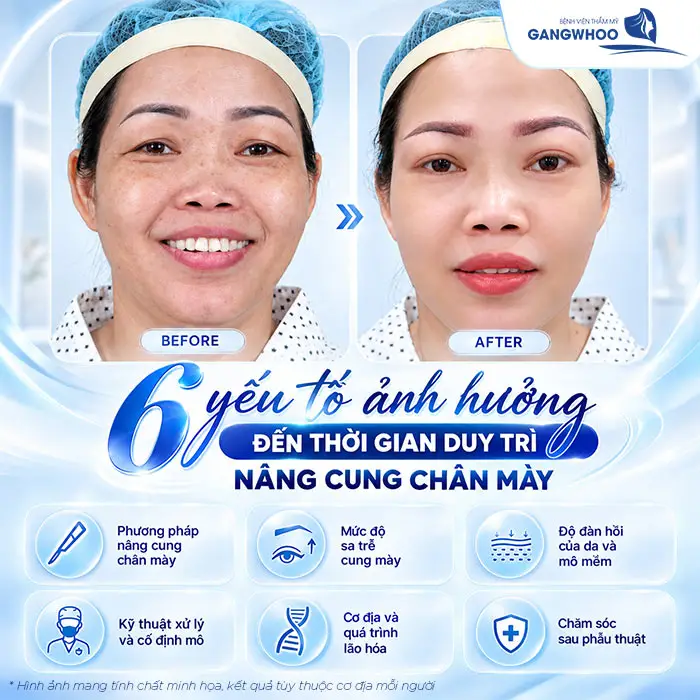 Nâng Cung Chân Mày Giữ Được Bao Lâu? Hướng Dẫn Chăm Sóc