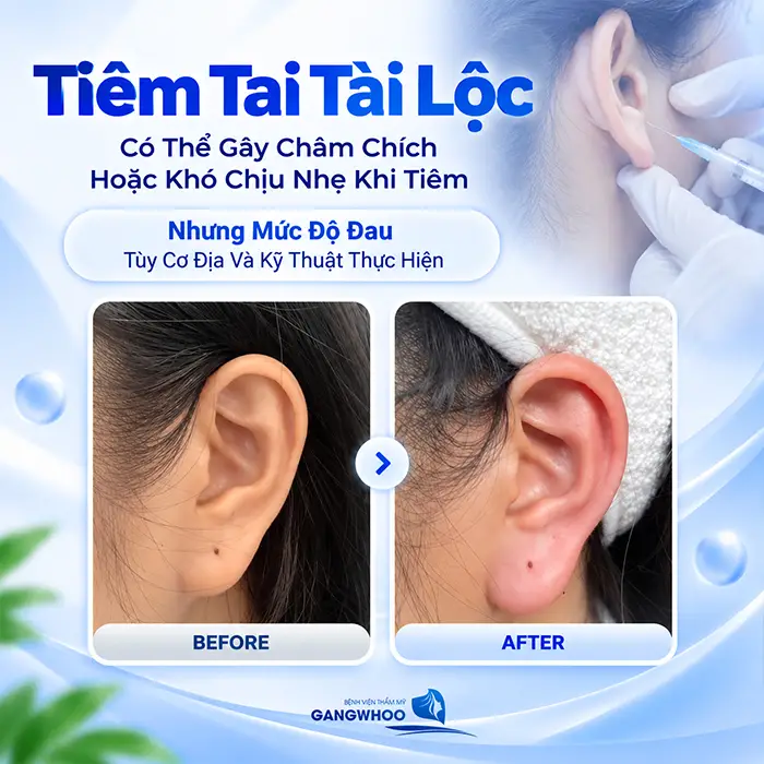Tiêm Tai Tài Lộc Có Đau Không? Mức Độ Đau Và Cách Giảm Khó Chịu