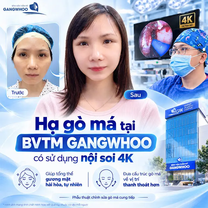 Hạ Gò Má Có Bị Xệ Mặt Không? Vì Sao Bị Xệ Mặt?