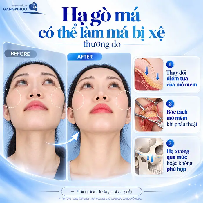 Hạ Gò Má Có Bị Xệ Mặt Không? Vì Sao Bị Xệ Mặt?