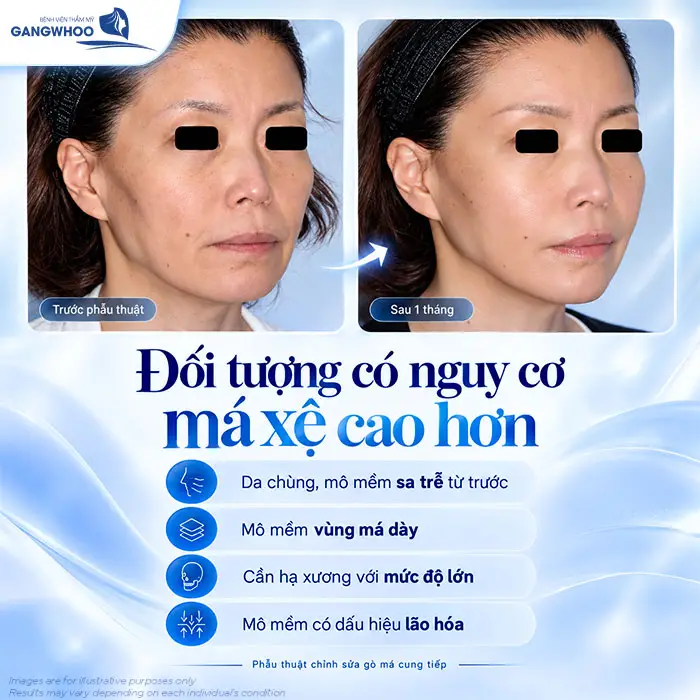 Hạ Gò Má Có Bị Xệ Mặt Không? Vì Sao Bị Xệ Mặt?