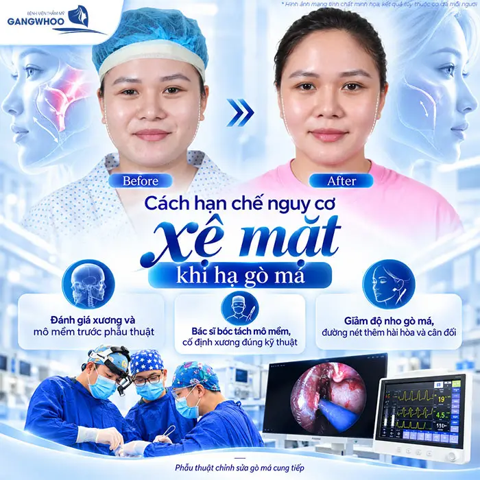 Hạ Gò Má Có Bị Xệ Mặt Không? Vì Sao Bị Xệ Mặt?