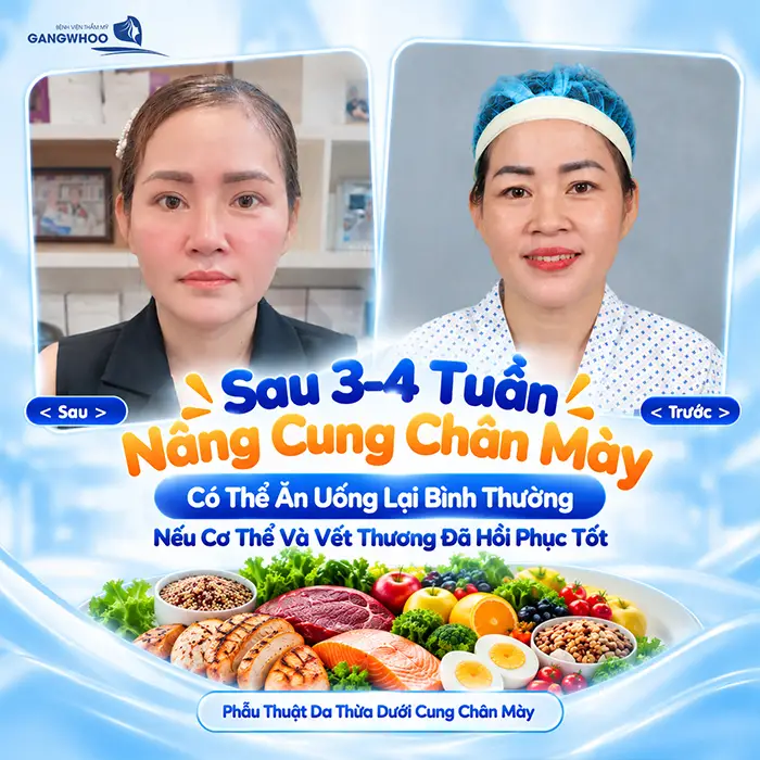 Sau Nâng Cung Chân Mày Kiêng Ăn Gì? Nên Ăn Gì Để Hỗ Trợ Hồi Phục?
