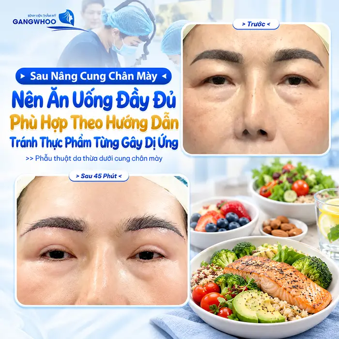 Sau Nâng Cung Chân Mày Kiêng Ăn Gì? Nên Ăn Gì Để Hỗ Trợ Hồi Phục?